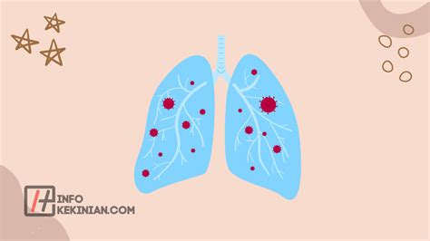 Mengenal Paru Paru Basah Pengertian Gejala Dan Penyebabnya - Riset
