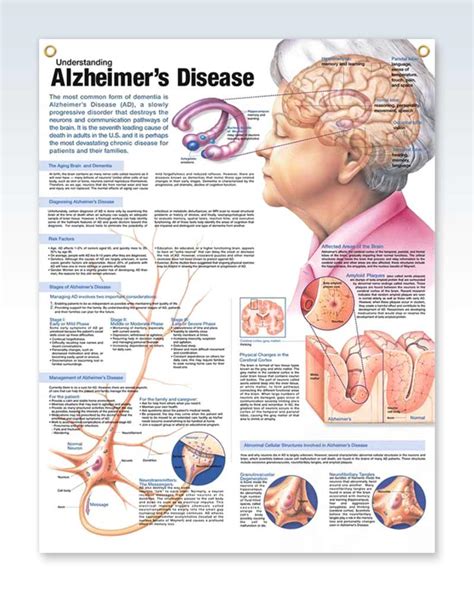 Alzheimer's Disease Exam-Room Anatomy Poster – ClinicalPosters