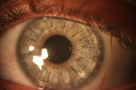 Image of Corneal Transplant