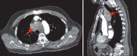 Goiter - The Operative Review Of Surgery