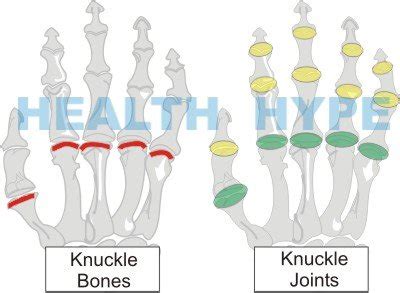 Knuckle Pain on Hand (Bones and Joints) Causes and Treatment | Healthhype.com