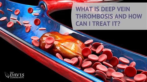 What is Deep Vein Thrombosis And How Can I Treat It? | The Davis Community