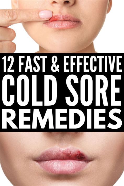 Fast and Effective: 12 Natural Cold Sore Remedies that Work in 2020 ...