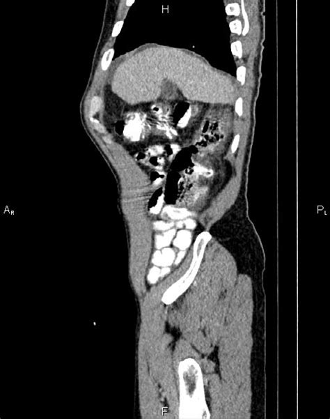 Caput medusae sign - portal hypertension (Radiopaedia 64007-72759 B) - NC Commons