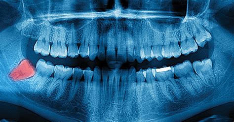 Are Wisdom Teeth Evidence for Evolution? | Answers in Genesis