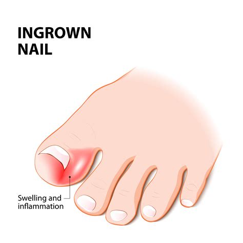 Everything you need to know about Ingrown Toenails | Feet First Clinic