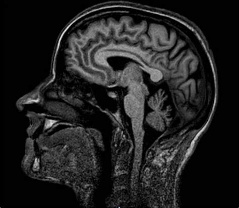 T1-weighted sagittal brain MRI scan showing cerebellar atrophy ...