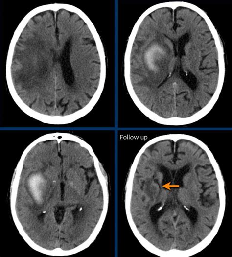 Brain Hemorrhage Scan