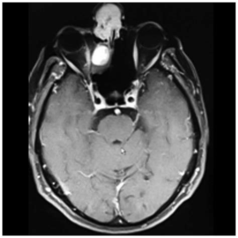 Olfactory neuroblastoma: A case report