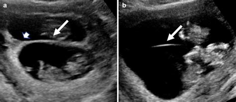 Multiple gestation pregnancy. a Transverse gray-scale ultrasound image... | Download Scientific ...