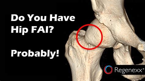 Hip FAI Surgery Recovery: New Study Says Everybody has Hip FAI