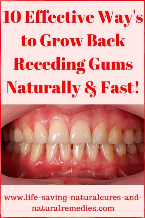 Wow! 8 Stunning Natural Remedies for Receding Gums...