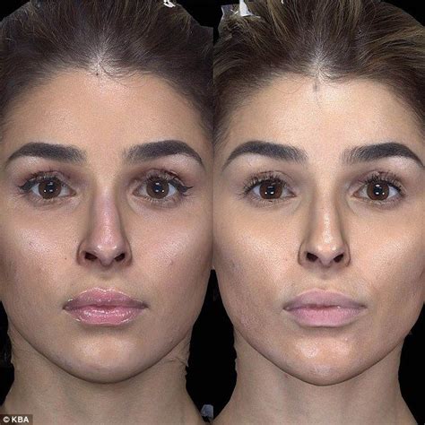 Women using plastic surgery to achieve Meghan Markle's golden ratio ...