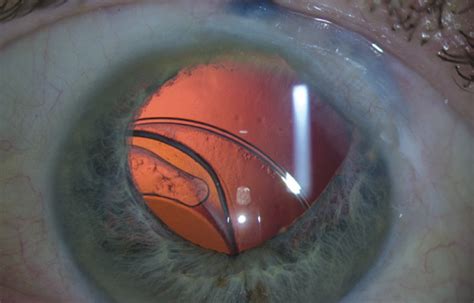 CRSToday | Dislocated IOL in an Eye With a History of Trauma