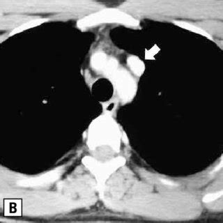 A. Frontal chest radiograph showing normal cardio-mediastinal contours;... | Download Scientific ...