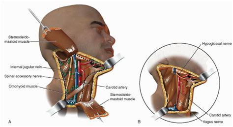 Radical Neck Dissection | Ento Key