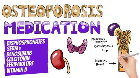 Osteoporosis Medications and Management | Which Drugs Are Used To Treat Osteoporosis? - YouTube