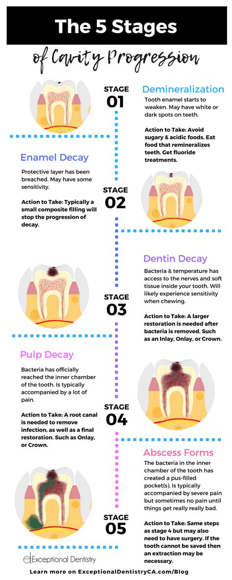 What Happens When a Cavity Is Left Untreated? - Exceptional Dentistry