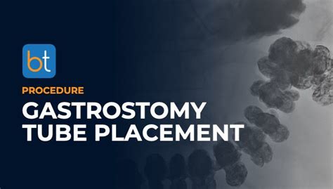 Gastrostomy Tube Procedure Prep | BackTable VI