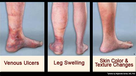 Chronic Venous Disease – Vascular Center of Michigan