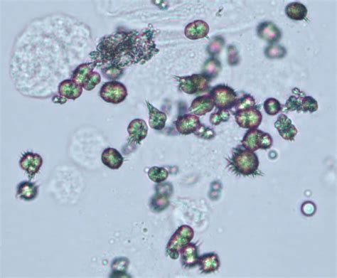 Types of Crystals in Urine