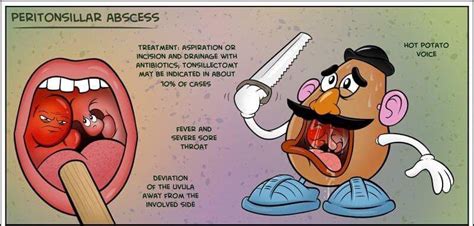 Absceso peritonsilar | Nurse, Nursing school studying, Medical illustration