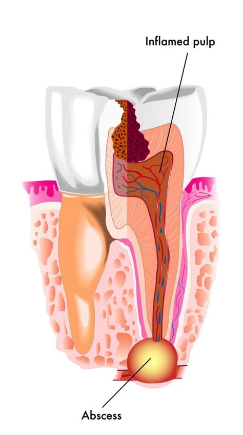 Do I Have a Dental Abscess? 6 Symptoms You Might Have a Dental Abscess