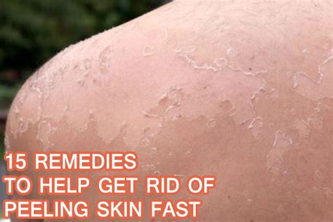 15 Remedies to Help Get Rid of Peeling Skin Fast || Getinfopedia.com