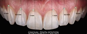 Gingival zenith point in dentistry | News | Dentagama