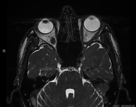 Microvascular Decompression and Radiofrequency Lesioning for Trigeminal Neuralgia - cns.org