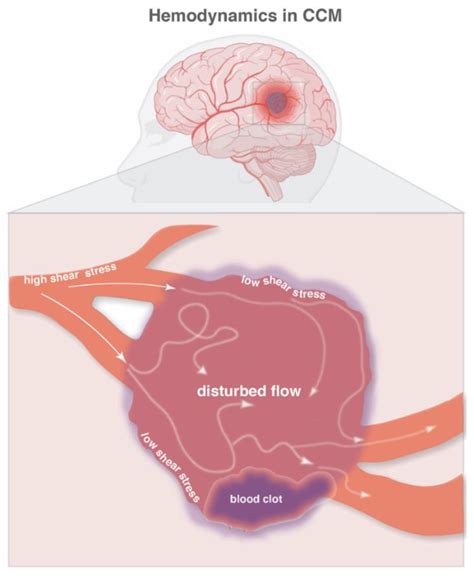 Cavernous Hemangioma Brain