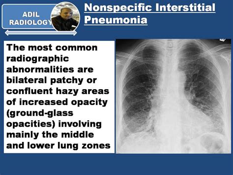 Interstitial Pneumonia X Ray