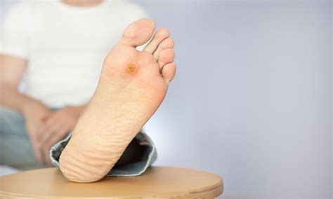 What Increases My Risk of Diabetic Ulcers on the Foot?: Midwest ...