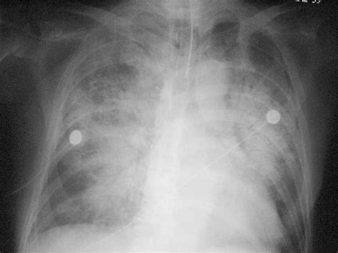 Radiology Lecture Notes: Imaging of Heart failure