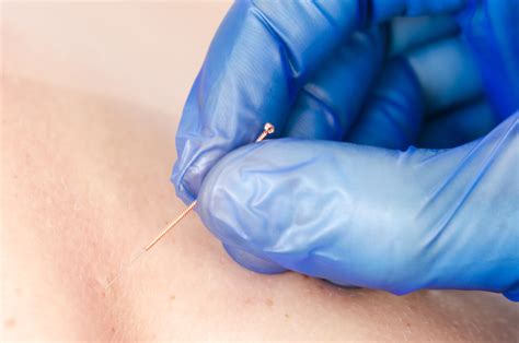 Dry Needling Side Effects | Aquidneck Chiropractic