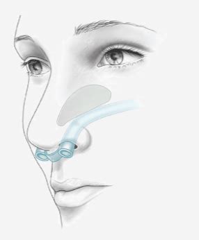 Rhinoplasty Surgery Recovery: Swelling, Healing Time & Stages, Tips & Recovery Timeline, How ...