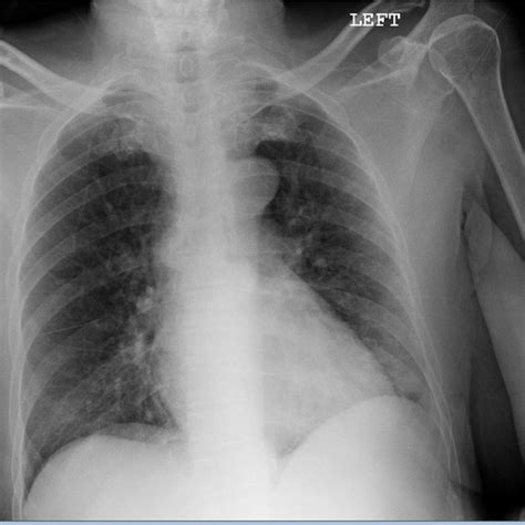 (PDF) Takotsubo cardiomyopathy precipitated by delirium tremens