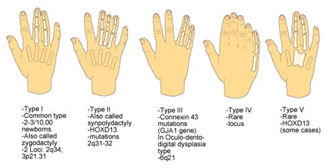 Hand Malformations » Division of Genetics and Metabolism » College of ...