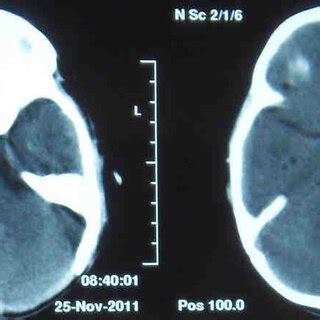 Postoperative images after craniectomy and drainage of empyema ...