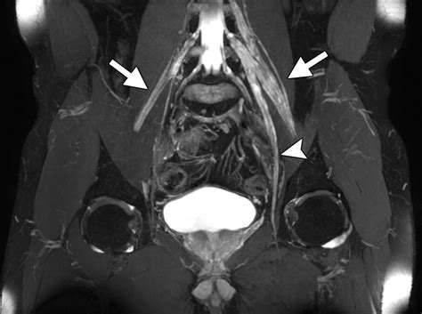 High-Resolution 3-T MR Neurography of the Lumbosacral Plexus | RadioGraphics