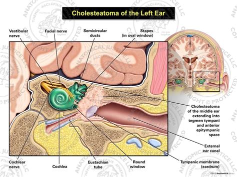 Cholesteatoma of the Left Ear