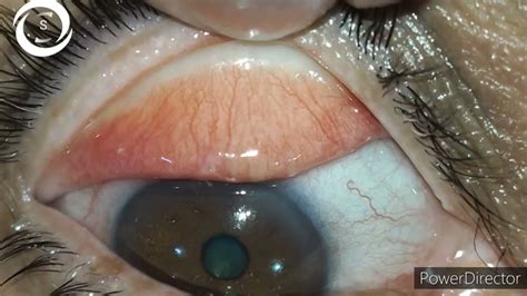 Conjunctival Concretions CC90 - YouTube