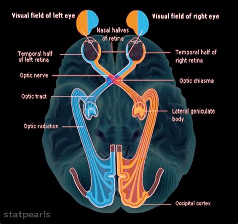 Neuroanatomy, Bitemporal Hemianopsia - StatPearls - NCBI Bookshelf