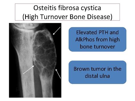 Bone and Mineral Disorders in Chronic Kidney Disease