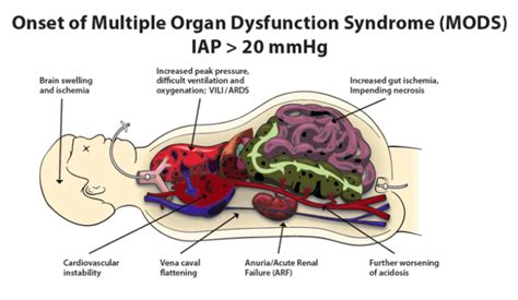 Intra-Abdominal Pressure…forgotten?! – Critical Care Northampton