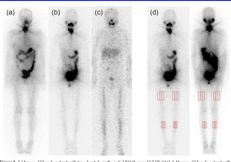 [PDF] Extremity Radioactive Iodine Uptake on Post-therapeutic Whole Body Scan in Patients with ...