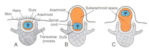 Myelodysplasia (myelomeningocele, spinal bifida) - Pediatrics - Medbullets Step 1