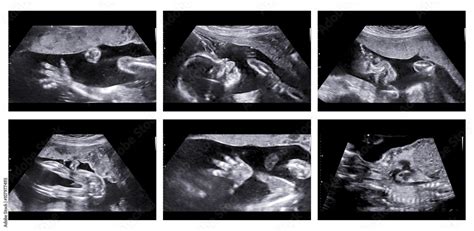 Collage of medical images of ultrasound anomaly scan on a female Stock ...