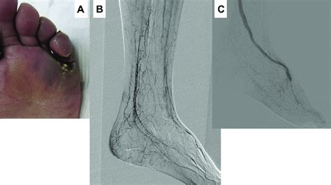 Patient 1. A, Photograph of the ischemic wound: cyanotic ulcer and a... | Download Scientific ...