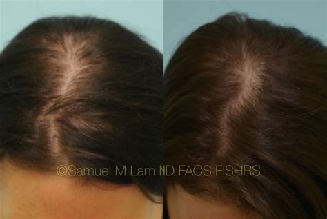 Dallas Laser Before and After Photos - Plano Plastic Surgery Photo ...